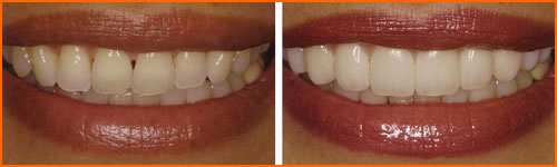 A before and after example of Veneers